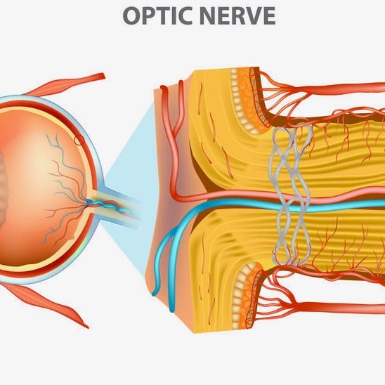 ischemic optic neuropathy ischemia anterior portion optic nerve Sleep Apnea