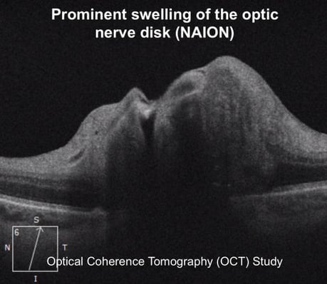 papilledema or swelling of the optic nerve Fedorov Restore Vision Clinic