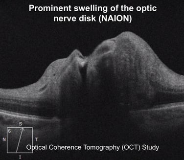 papilledema or swelling of the optic nerve Fedorov Restore Vision Clinic