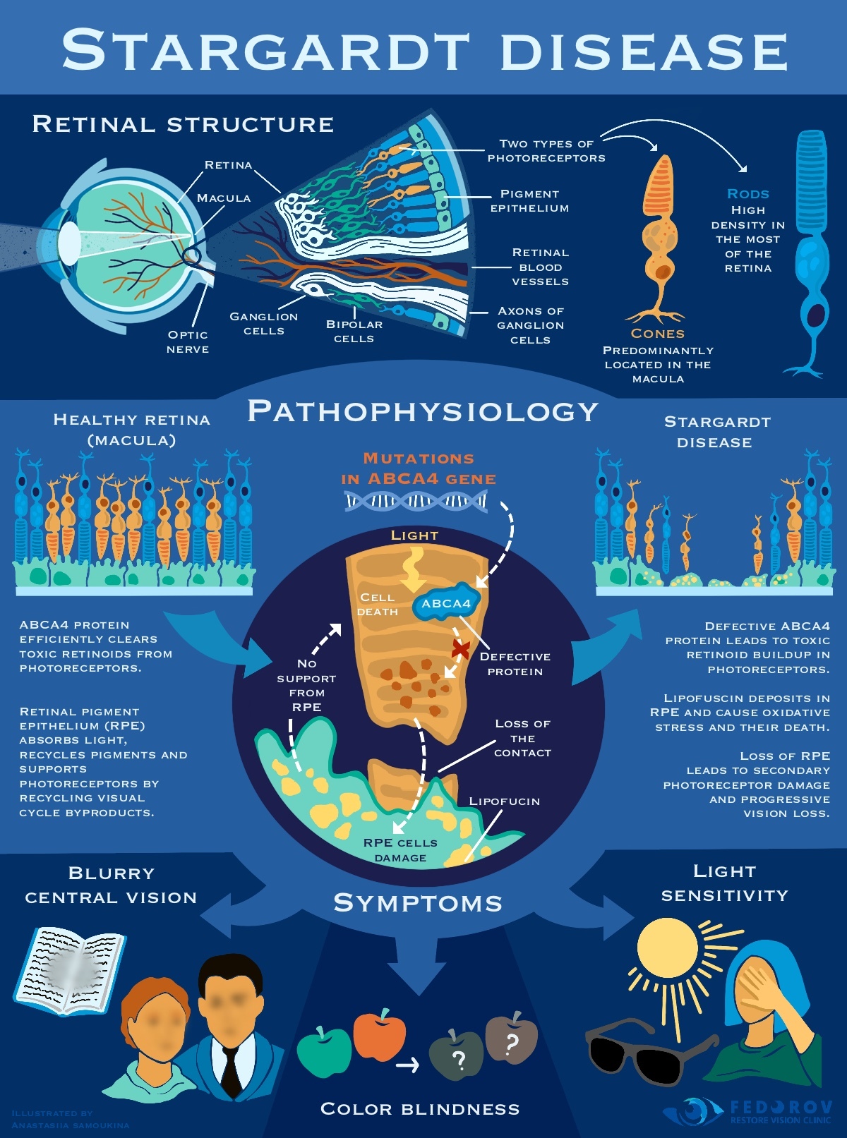 Stargardt disease infographic showing retinal structure, ABCA4 gene mutation, symptoms, and vision loss